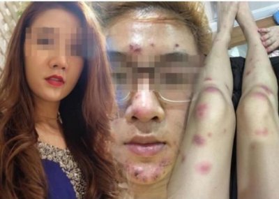 ​爱美有风险：泰国女子注射美白针后脸变烂