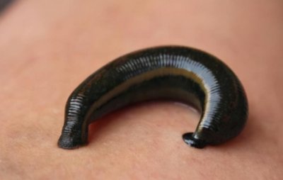 ​蚂蟥能在人体中生存多久？男孩鼻腔中发现蚂蟥，已被寄生半月