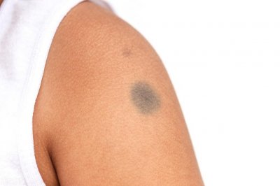 ​胎记的前世今生，传说胎记是前世留下的印记？