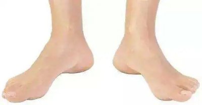 ​走路外八需要怎样纠正？